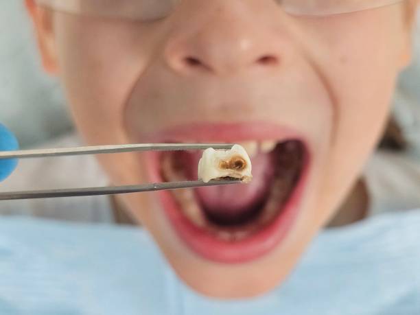 Best Broken or Chipped Tooth Repair in Ddanelle, AR